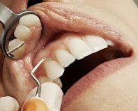 One Day Dental Implants Service