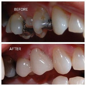 dental sealants