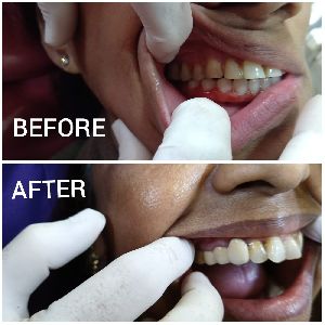 Root Canal Treatment