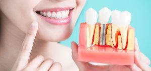 Dental Implants