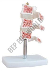 Osteoporosis Bone Joint Model