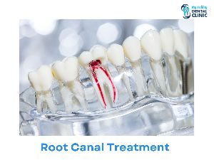 Root Canal Treatment