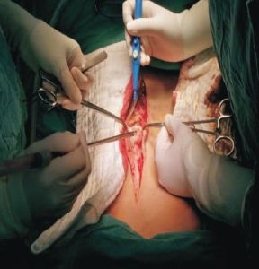 Non Sterile Absorbent Mopping Pad