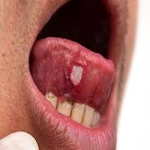 Tongue Cancer Treatment Service