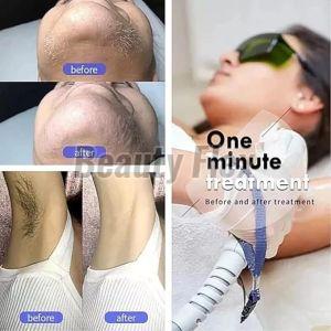 808nm Laser Hair Removal Machine
