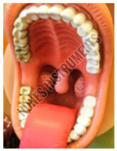 Plastic Carcinoma Tongue Pathology Model