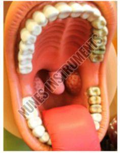 Plastic Carcinoma Tongue Pathology Model