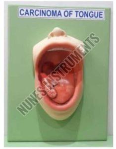 Plastic Carcinoma Tongue Pathology Model