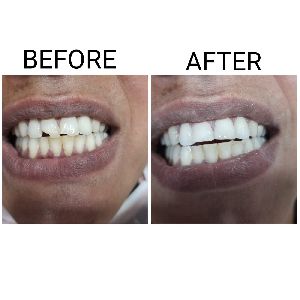 Laser Fillings