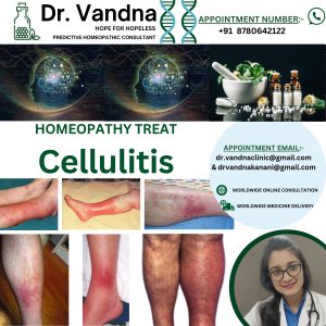 Best Homeopathy Doctor Skin Specialist For Cellulitis