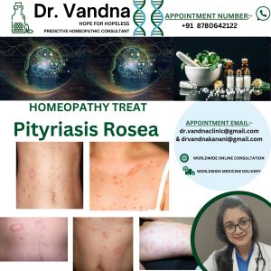 Online Homeopathy Consultation Skin Treatment Pityriasis Rosea