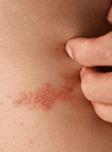Bacterial Skin Infection Treatment