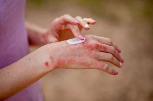 Eczema Treatment Service