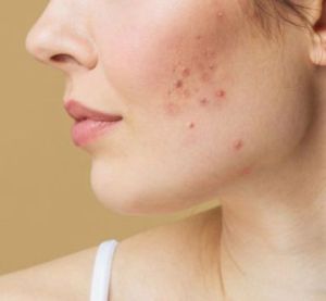 Pimple Treatment Services