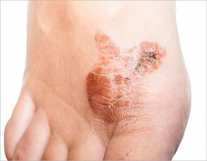 Skin Fungal Infection Treatment Service