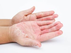 Skin Infection Treatment Service