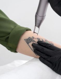 Permanent Tattoo Removal Services