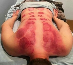 Back Pain Cupping Therapy Service