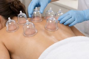 Hijama Cupping Therapy Service