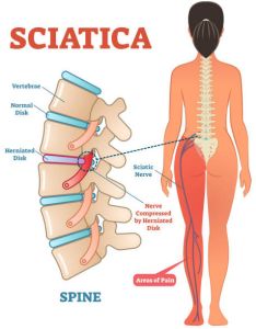 Sciatica Pain Acupressure Therapy Service