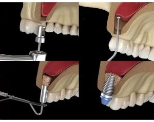 Xcem Osspore Bone Grafts For Sinus And Implantitis Repair
