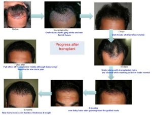 Process after hair transplant