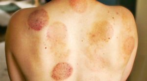 Cupping Therapy