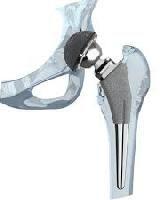 Hip Prosthesis