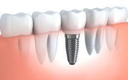 Dental Implants