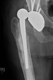 Hip Prosthesis