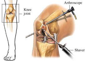 arthroscope