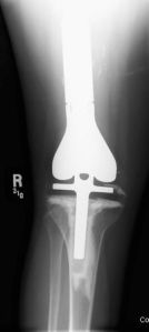 orthopedic bone plates lower leg prosthesis