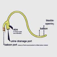 Foley Catheter