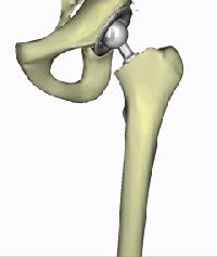 orthopedic prosthesis