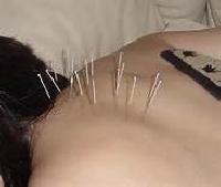Acupuncture Therapy 03