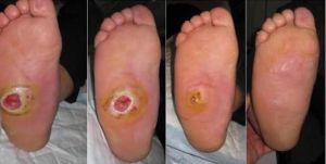 Gangrene Treatment