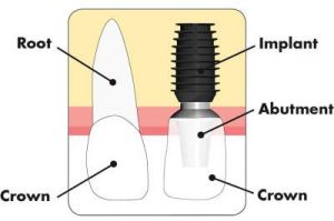 dental implant treatment