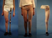 Hip Disarticulation Prosthesis