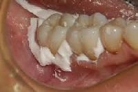 Dental Cements