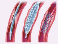 coronary stents