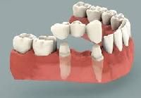 dental bridges