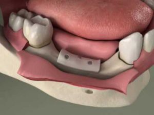 Bone Grafting