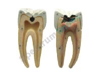 Dental Caries Model