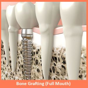 Bone Grafting