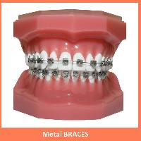 Metal braces