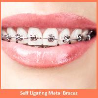 Self Ligating Metal Braces