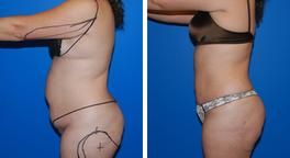 Liposuction Surgery