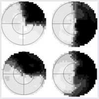 Visual Field Screener