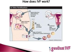 Infertility Treatment