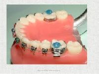 orthodontic appliances